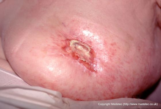 Sloughy wound formed following treatment for breast cancer